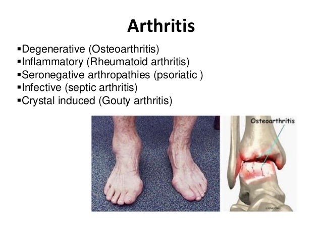 Ankle and foot pain